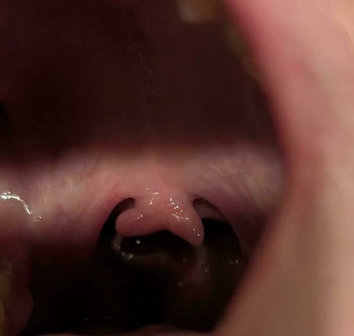 Küçük Dilin İkiye Ayrılması: İkili Uvula