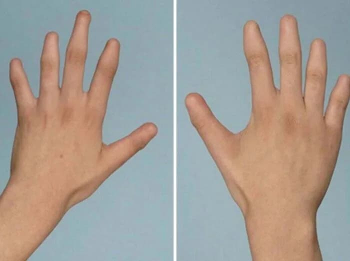 Doğuştan Tırnaksızlık (Anonychia Congenita) Nedir?