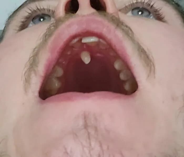 Çenede Normalden Fazla Dişlerin Olması: Hyperdontia