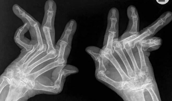 Romatoid Artrit: Kemik ve Eklem Yapısında Görülen Değişim